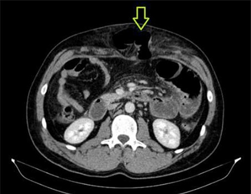 CT abdomen showing abdominal wall hernia containing a loop of small intestine (green arrow).