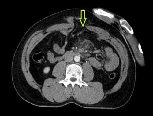 CT abdomen showing abdominal wall defect (green arrow).