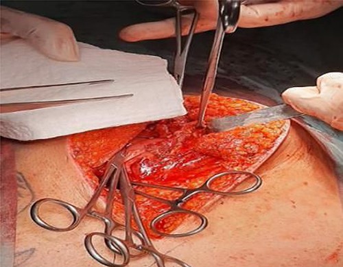 Operative findings. Disruption to muscular layers and peritoneum from handlebar injury, revealing small bowel. Clips placed on posterior rectus sheath.
