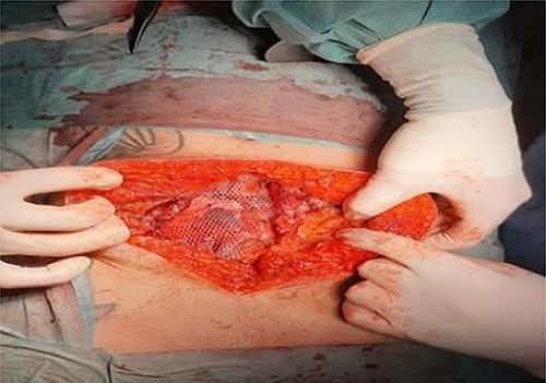 Operative findings. Retromuscular sublay mesh repair.