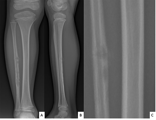 Anteroposterior (A) and lateral (B) radiographs of right fibula showing pathological fracture on a cortical bone lesion of mixed osteolytic and osteoformative character with bone callus.