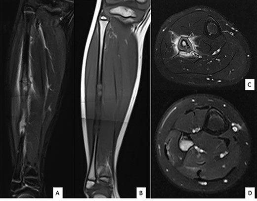 MRI of the right fibula: coronal MR STIR imaging (A); T1-weighted imaging (B); axial T2 FAT SAT section of the proximal part (C) and distal part (D) of the lesion. MRI shows areas of osteolysis around a medullary cavity narrowed by cortical thickening (sclerosis) and diffuse tissue inflammatory edema leading to suspicion of chronic osteomyelitis.
