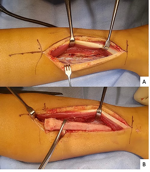 Posterolateral approach for fibulectomy.