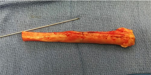 Fibulectomy (segment of 14 cm).