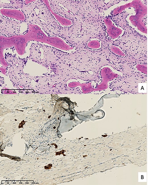 Pathological anatomy. (A) Hematoxylin & eosin staining; (B) Cell islands positive for cytokeratin AE1/A3 immunohistochemistry.