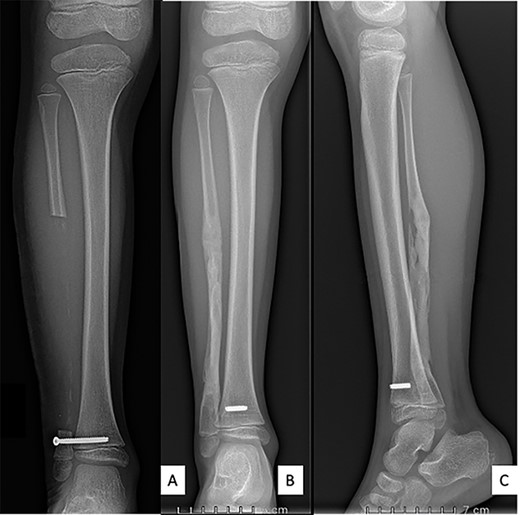 Anteroposterior radiograph and lateral view after right fibulectomy. (A): at 2-postoperative-weeks: preservation of the periosteum allowed progressive formation of new bone. (B) and (C): at 1-postoperative-year: a new fibula is reappeared. The syndesmosis screw broke with weight-bearing and only the fibular part of the screw was removed.