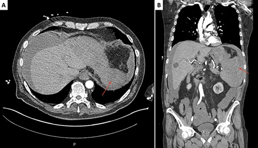 Initial CT scan of the abdomen and pelvis, axial (A) and coronal (B) slices, revealing a splenomegaly and a large ruptured supcapsular splenic hematoma (red arrows).