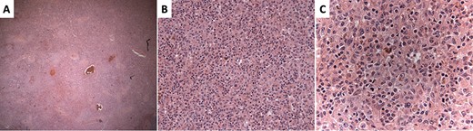 Hematoxylin and eosin–stained sections of the splenic red pulp. (A) ×4 magnification showing vague, nodular appearance. (B) ×10 magnification showing dendritic background with abundant eosinophilic cytoplasm. (C) ×20 magnification demonstrating atypical cells with cells resembling Langerhans cells showing irregular nuclear grooves and clefts.