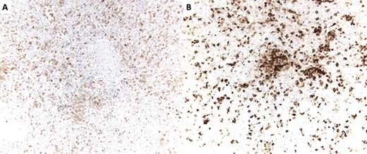 (A) S100 immunostain highlighting dendritic cells. S100 is also a marker of Schwann cells and melanocytes. (B) CD1a immunostain highlighting dendritic cells. CD1a is also an immunostain for Langerhans cells.