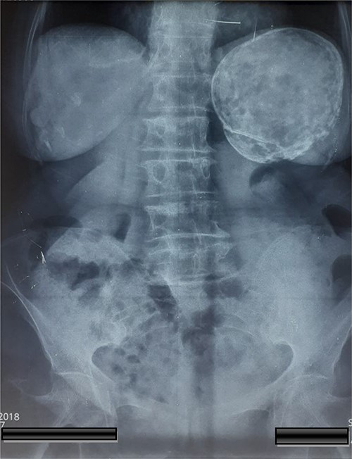 Abdominal X-rays with a calcified cyst at the left upper quadrant of the abdomen.