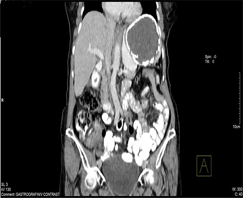 CT of the abdomen shown a 10.5 × 9.6 × 9.5-cm ovoid splenic cyst with peripheral rim calcification.
