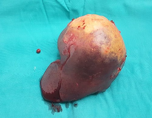 The splenectomy specimen with accessory spleen.
