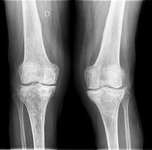 Initial both-legs standing radiographs of the knee. It showed a pattern of diffuse osteopenia with areas of sclerosis, lateral extended bone reaction and decreased lateral articular space (Kellgren–Lawrence 3) in the left knee. Bone necrosis with decreased medial articular space (Kellgren–Lawrence 3) were observed in the right knee.