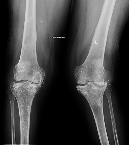 Standing X-rays of the left knee 8 months later showed collapse with depression of the external tibial plateau and associated bone defect that caused 28° valgus deformity.