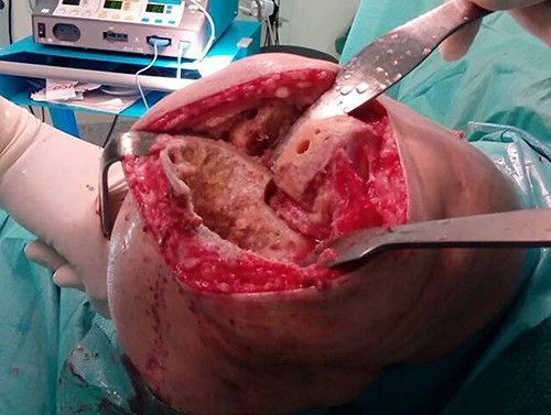 Surgical photograph showing the large bone defect.