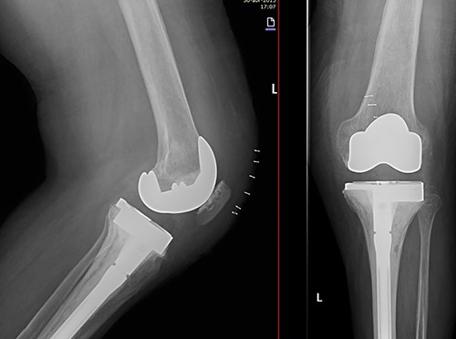 X-ray of the left knee showing reconstruction with 10-mm tibial lateral block and a tibial diaphyseal stem.