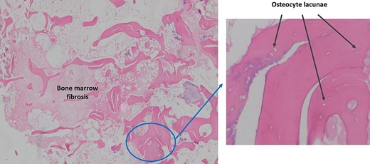 Pathological sample 1: bone marrow fibrosis on the left and osteolysis with empty lacunae enlarged in perimeter without osteocytes on the right.