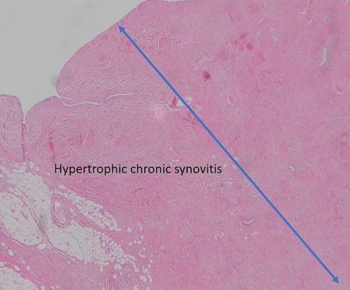 Pathological sample 2: hypertrophic chronic synovitis, without signs of acute inflammation, evidencing a long evolution of the process.