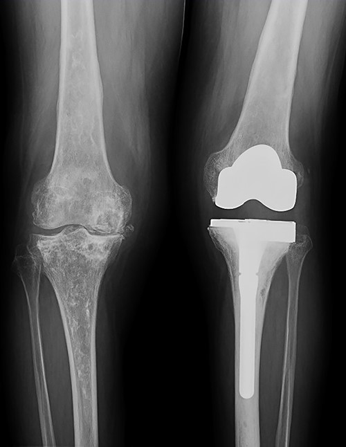 Evolution of the right knee by standing radiographs during follow-up with progression toward joint space disappearance (Kellgren–Lawrence 4) in a severe varus deformity.