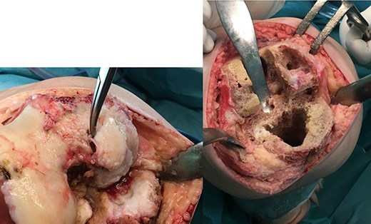Surgical photograph showing the large bone defect in the right knee especially in the femoral condyles.