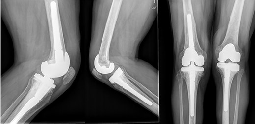 Both knees standing radiographs at 4-year follow-up with no signs of radiological loosening.