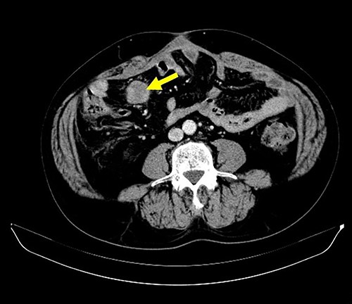 CT finding. Follow-up CT after gastrectomy for gastric cancer revealed a mesenteric tumor. There were no other malignant findings.