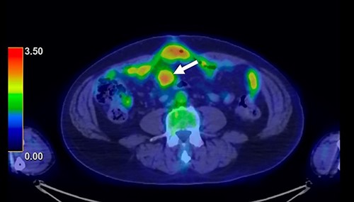 PET-CT finding. PET-CT showed that the maximum standardized uptake value (SUV max) of the mesenteric tumor was 2.9, with no other tumors present in the whole body.