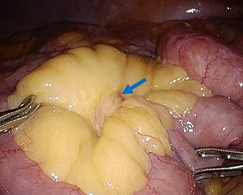 Laparoscopy finding. Laparoscopy showed a tumor in the mesentery of the small bowel, not arising from the bowel wall, with no obvious metastatic tumors of the liver or peritoneum.