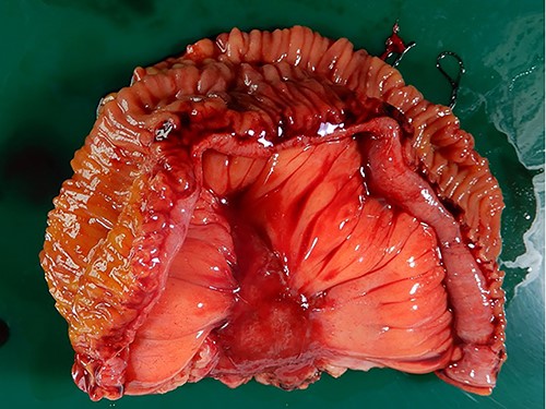 Macroscopic findings of the surgical specimen. Macroscopic findings revealed an intramesenteric tumor of the small bowel, not exposed to the abdominal cavity or the bowel lumen.