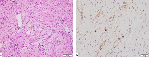 Pathological findings (a: hematoxylin and eosin staining, b: immunohistochemical staining for c-kit). Pathological findings showed that the mesenteric tumor was a GIST and c-kit-positive and CD34-, SMA- and S100-negative, with a low Ki-67 proliferation index (<5%).