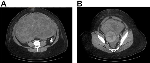 (A) CT abdomen and pelvis with contrast identified a large pelviabdominal mass with internal vascularity measuring 29 × 19 cm and significant ascites; the mass contained both cystic and solid components. (B) The mass encasing the uterus.