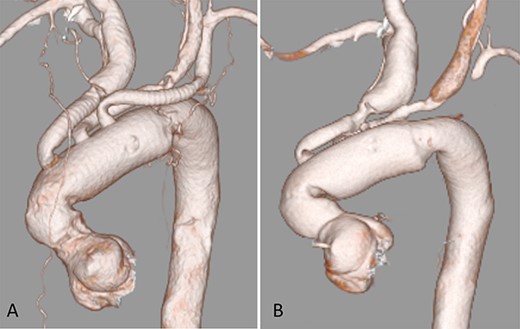 CECT 3D reconstruction; (A) after initial operation; (B) 19 months after the operation