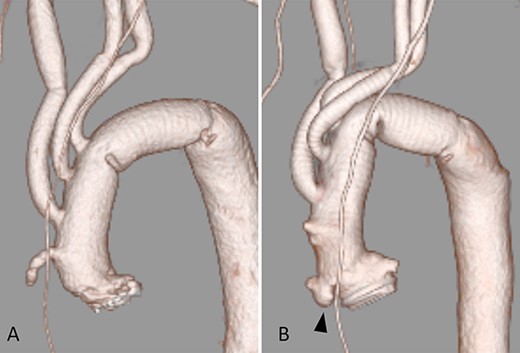 (A) After AVR and TAR; (B) 10 months after the operation; arrow shows a pseudoaneurysm of the ascending aorta