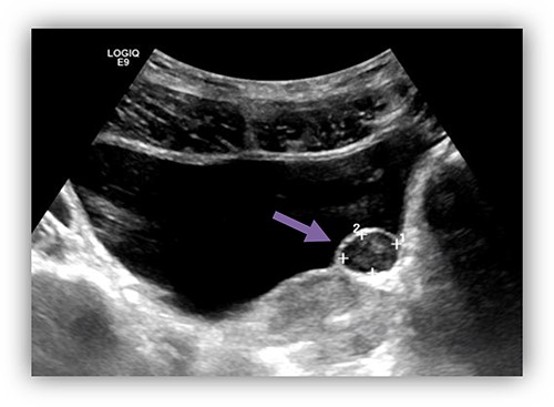 US bladder showed a cystic fluid-field bladder mass of 15 mm × 11 mm over the area of left vesicoureteric junction suggestive of left ureterocele.