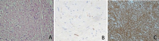 Histopathological studies show that there is a proliferation of spindle-shaped cells, in addition to an eosinophilic cytoplasm and fibers, with no evidence of mitotic changes or atypia (A). Leiomyomas of the urinary bladder also stain negatively for Ki-67 (B), but they are positive for smooth muscle staining (actin) (C).