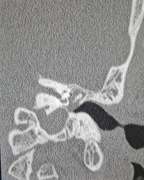 Coronal computed tomography image showing the mass with soft tissue density filling the middle ear cavity.