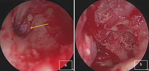 (a) Tumor mass in the eardrum, blue arrow: tumor; yellow arrow: corda tympani. (b) Complete resection of the tumor.