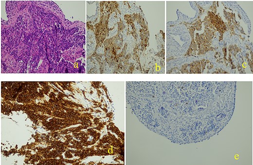 Histopathological and immunohistochemical examinations: (a): Neoplastic cells are organized to great extent in crowded glandular formations, while surrounding stroma is characterized by fibrosis and hyalinosis, (b): chromogranin +, (c): synaptophysin +, (d): cd56 +, (e): ki67 +.