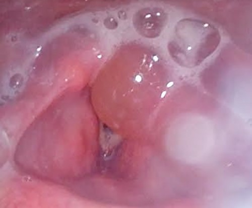 Laryngoscopy findings.
