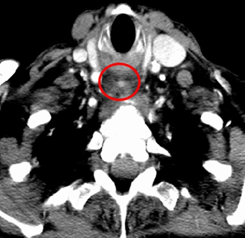 CT neck; post-cricoid mass containing an air locule with a 3-mm hyperdense mass (red circle) in the caudal end of this.