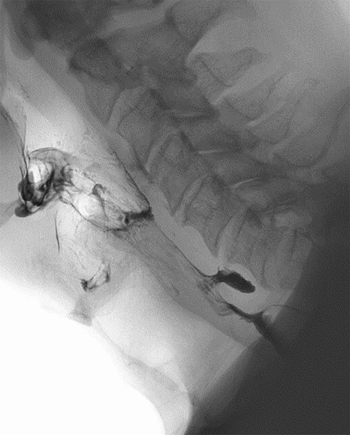 Barium swallow demonstrating 1.1-cm ZD.