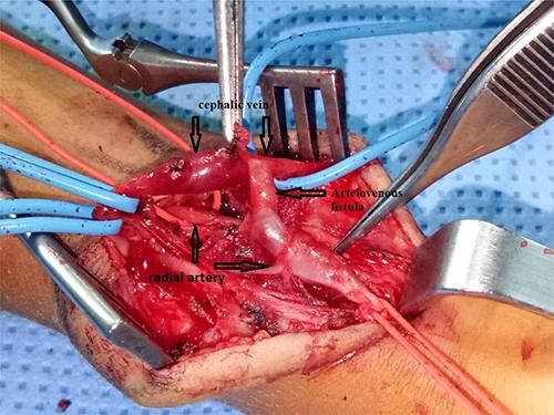 Surgical exploration showing an arteriovenous fistula between the radial artery and the cephalic vein of the forearm.
