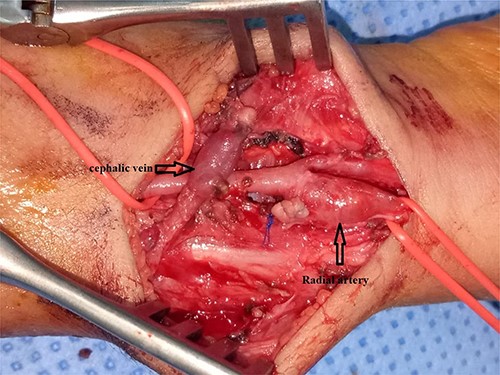 Ligation of the arteriovenous fistula and the radial artery was preserved and repaired with 7-0 Prolene sutures.