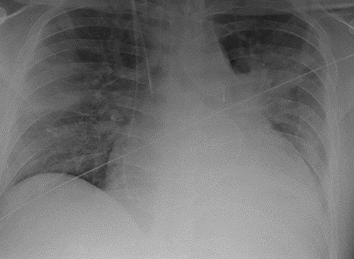 Chest radiograph demonstrating pulmonary oedema prior to implantation of biventricular assist device.