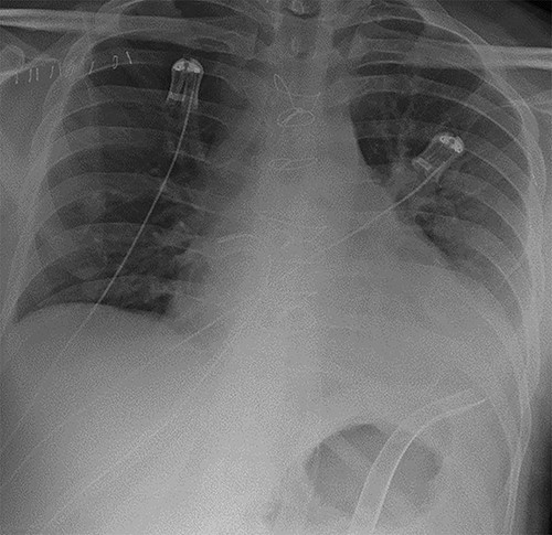 Chest radiograph demonstrating biventricular assist device pipes in situ and resolution of previous pulmonary oedema.