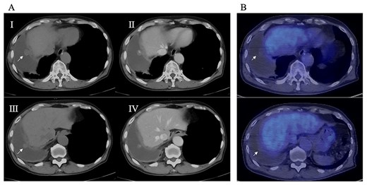 (A) Preoperative CT; right pleural effusion was present, and a 17 × 10 mm nodule (I) and a 10 × 10 mm nodule (III) were found on the right diaphragm; contrast medium staining from the center (II, IV), and (B) preoperative PET-CT; no accumulation of FDG was observed in the diaphragmatic nodules.