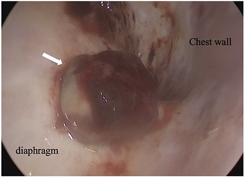 Intraoperative thoracoscopic image, and two consecutive reddish, smooth nodules were observed on the surface of the diaphragm.