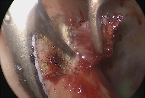 Intraoperative thoracoscopic image, and the diaphragm layer was peeled off with the active blade of the ultrasonic coagulation and incision device.