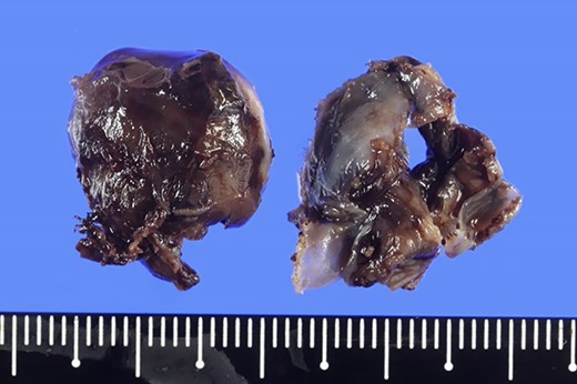 Excised hemangioma, and the nodules were 1.7 × 1.7 cm and 1.5 × 1.5 cm with a brown surface.