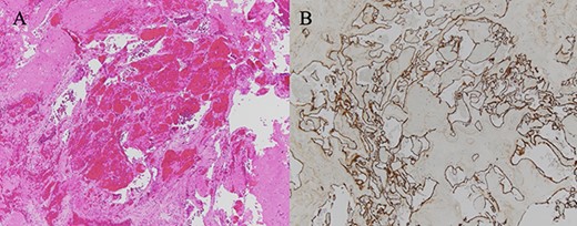 (A) HE-stained image of the specimen, and a collection of blood vessels was observed; (B) CD34 staining was positive, confirming the presence of vascular endothelium.